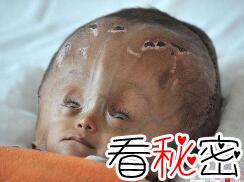 超大头娃娃罗娜·贝古姆，头围3倍巨大(受尽折磨悲惨离去)