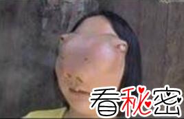 异脸河马女孩，病魔驱使下的少女（太可怜了）
