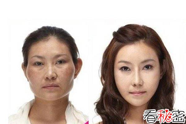 韩国整容术