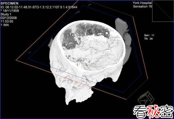 铁器时代人类大脑扫描图