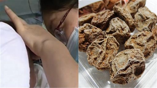 8岁童称「鼻有石头」父母不信！ 半年后医从鼻中勾出话梅核