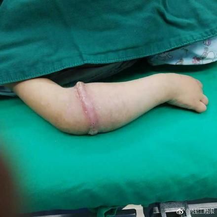 4岁女童长罕见「粉色肉环」 竟是「手臂吃了橡皮筋」