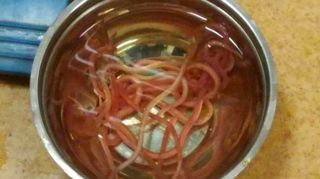别以为是食物！轻熟女体内藏14条活虫「痛到站不直」