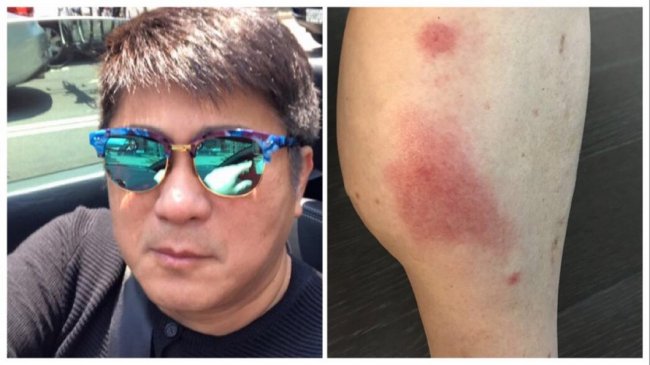 胡瓜被小黑蚊叮差点截肢！腿整只肿成「战斧」