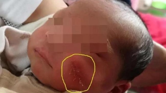 女婴出生就毁容 剖腹产划伤宝宝左脸医师竟装死
