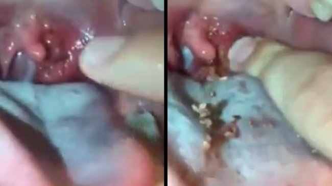 手挤「扁桃腺结石」爆浆白粒大喷射 网友直作呕