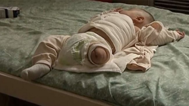 护理师忘关吹风机直吹小孩1小时　男婴腿烧黑遭截肢
