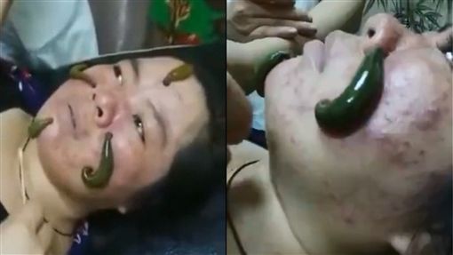 女子用「水蛭」敷脸！治痘痘吓坏网友 美容师：千古疗法
