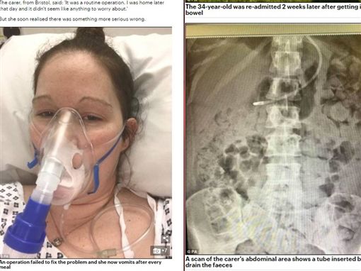 一吃饭就吐大便 她微创手术失败肠道受损粪便渗透体内