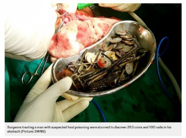 印度男子胃藏7公斤异物 吞100铁钉263硬币