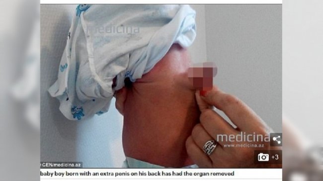男婴背上「多一根」生殖器 双胞胎兄弟寄生的