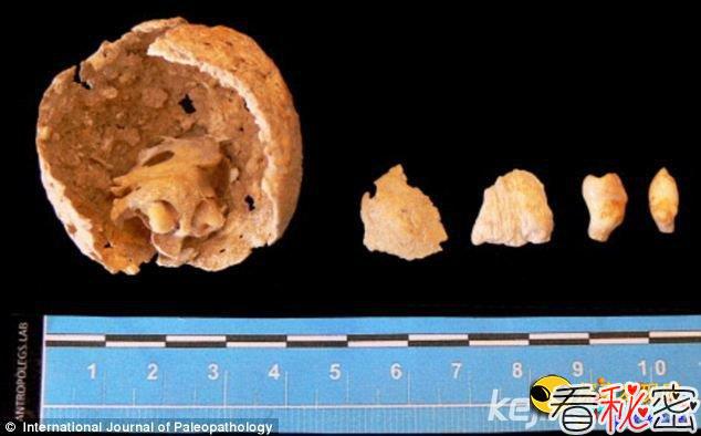 在一个墓地中1600年的罗马尸体发现肿瘤露齿