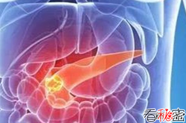 胰腺癌发病率最高的十大国家 无中国,日本榜上第七