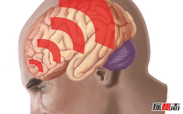 脑震荡多久能恢复正常?脑震荡对人体的十大危害