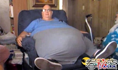 美国男子腹部长200磅大肉瘤 形如土豆人